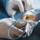 Chirurgie réfractive par LASIK : une solution efficace pour une vision nette